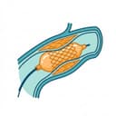 Angioplasty