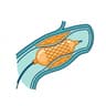 Angioplasty